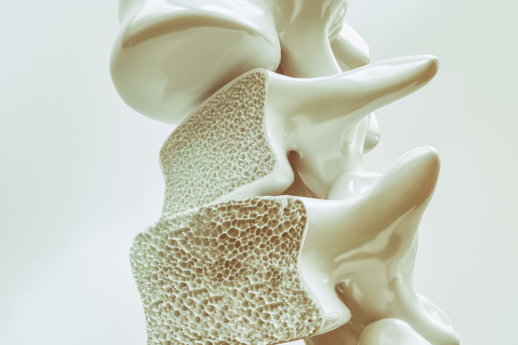 model of osteoporosis bone density in the lower spine